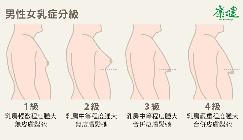 男性女乳症程度