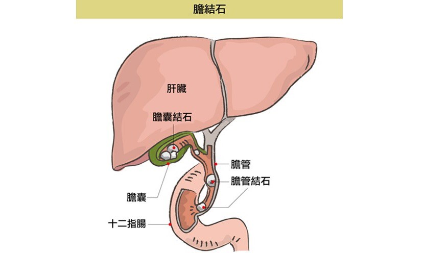 膽結石-膽囊-肝膽排石