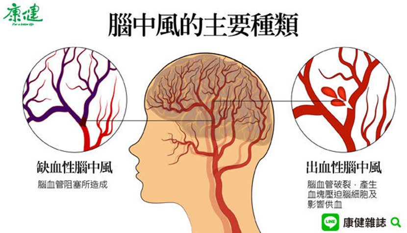 腦中風-缺血性腦中風-出血性腦中風