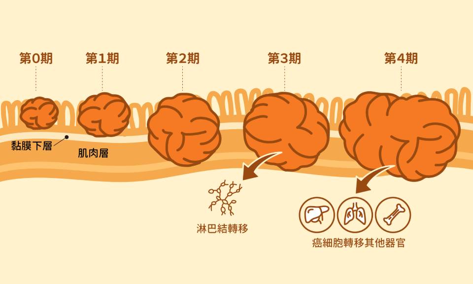 配合大腸癌分期，該如何選擇治療分針？