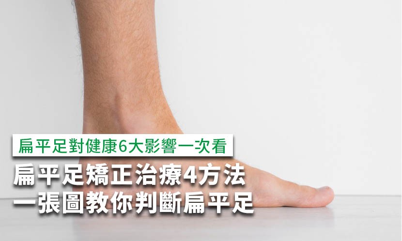 扁平足矯正治療4方法，一張圖判斷扁平足