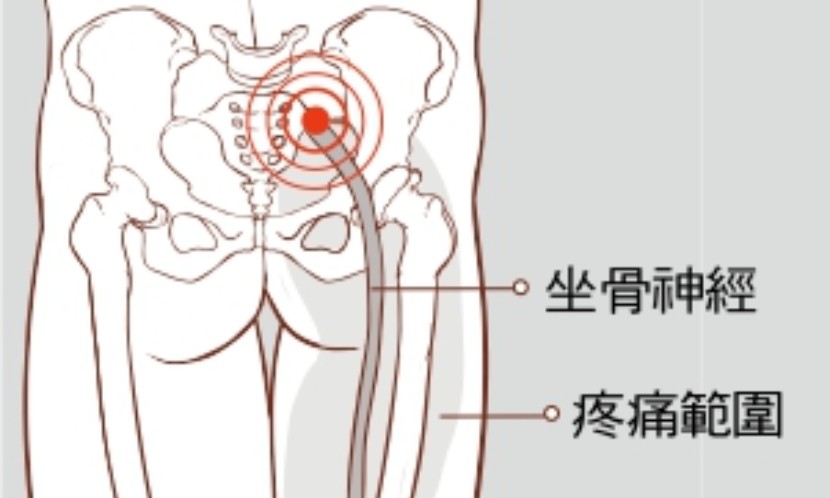 坐骨神經痛是怎麼發生的?