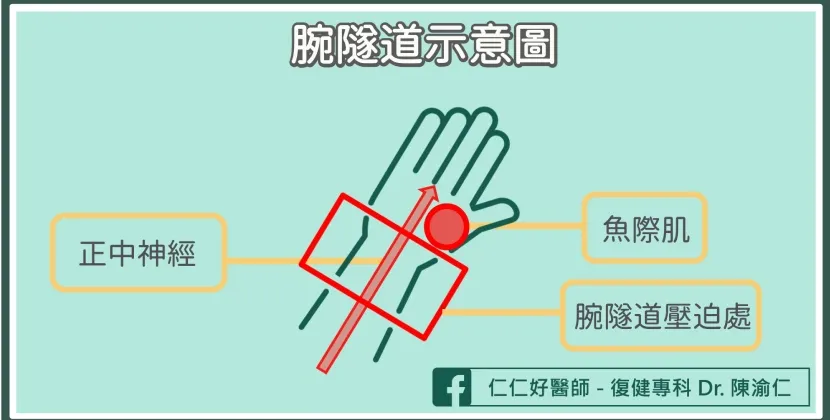 腕隧道症候群