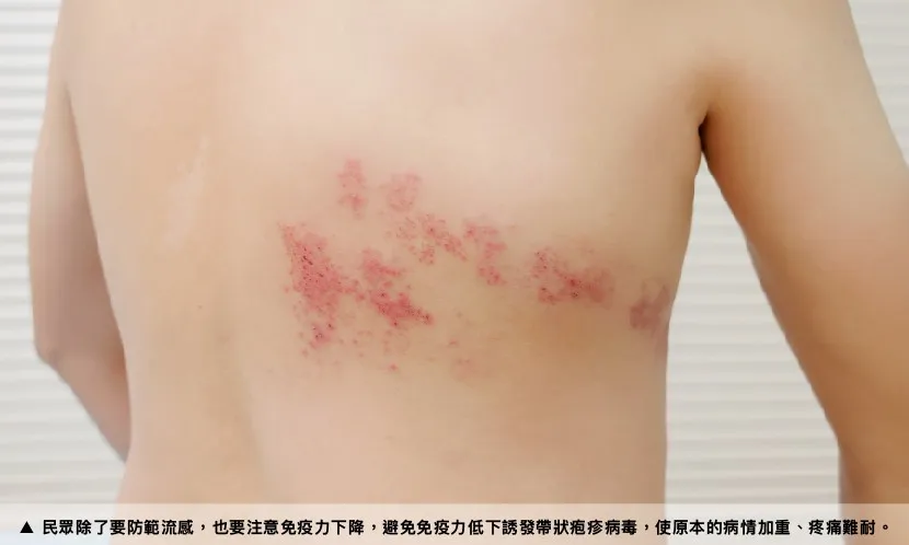 民眾除了要防範流感，也要注意免疫力下降，避免免疫力低下誘發帶狀疱疹病毒，使原本的病情加重、疼痛難耐。