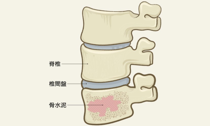 椎間壓迫性骨折需要灌漿嗎?