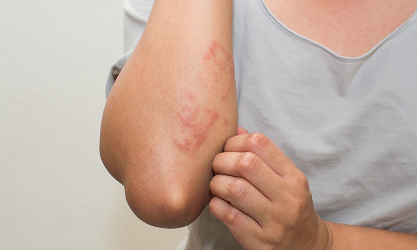 濕疹怎麼辦？醫師一次解析濕疹原因、症狀及如何預防、止癢