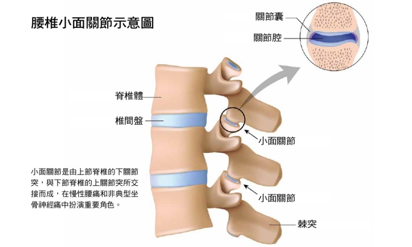 痛到歪腰,可能是腰椎小面關節炎?