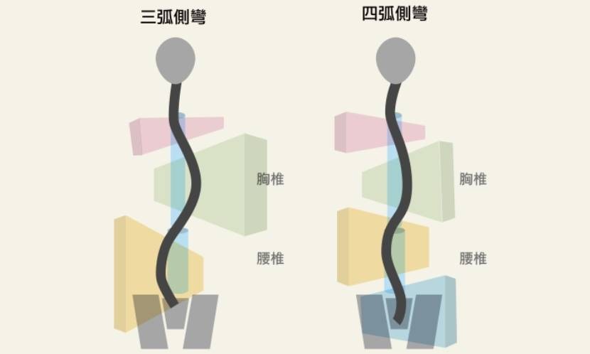 成年後發現脊椎側彎,現在開始治療會不會太慢?