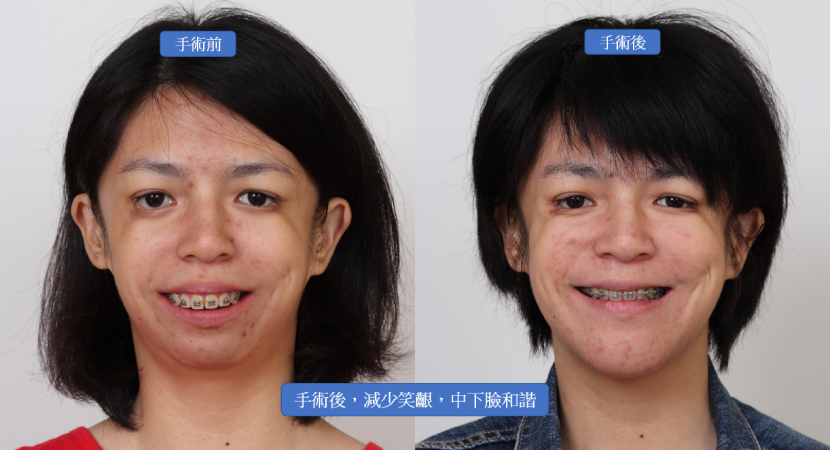正顎手術 正面照