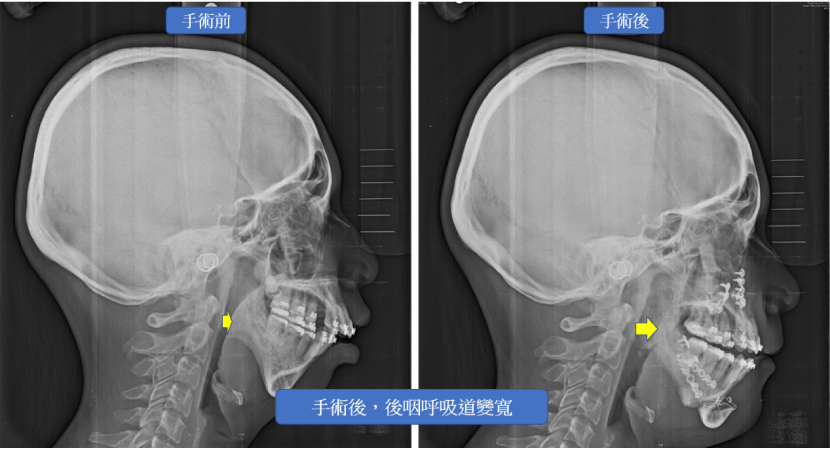 正顎手術 呼吸道前移的移動差距