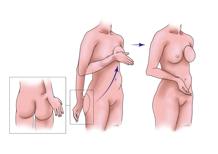 乳房重建 義乳 皮瓣 胸部 臀肌 小腹