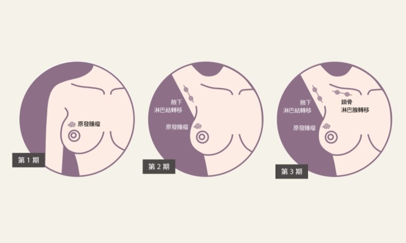 乳癌 分期 腫瘤 轉移 淋巴結