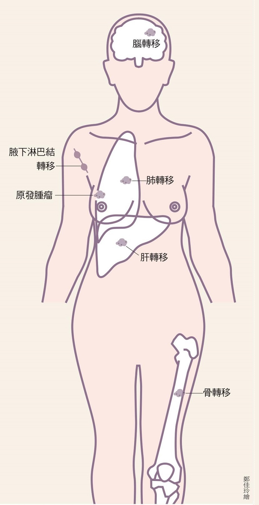 乳癌 分期 腫瘤 轉移 淋巴結