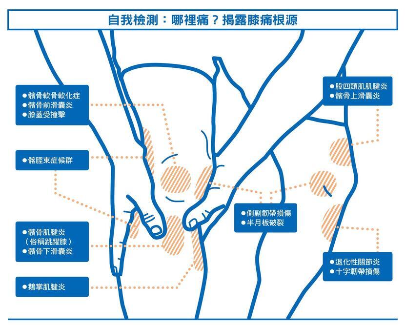 關節炎 肌腱炎 膝蓋痛 跑者膝 關節退化