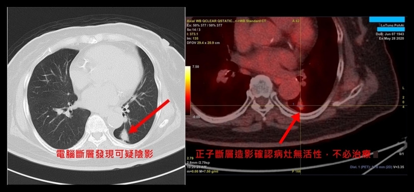 癌症治療 放射線治療 正子斷層