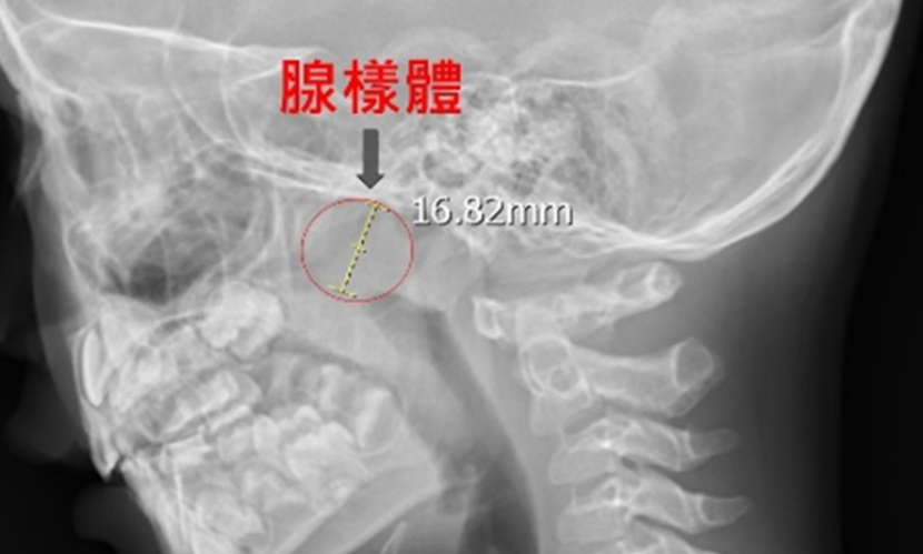 兒童 腺樣體腫大 鼻咽 發炎 鼻涕 鼻塞