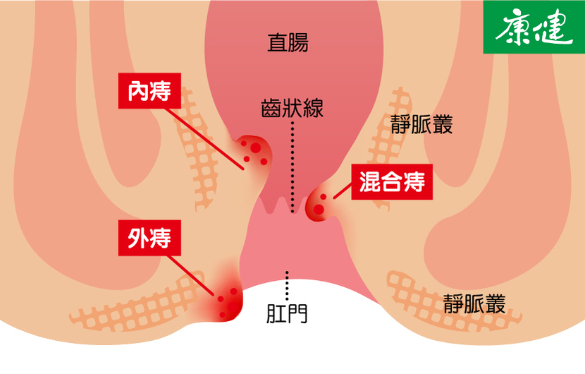 痔瘡-症狀-治療-手術-藥膏-內痔-外痔-混合痔
