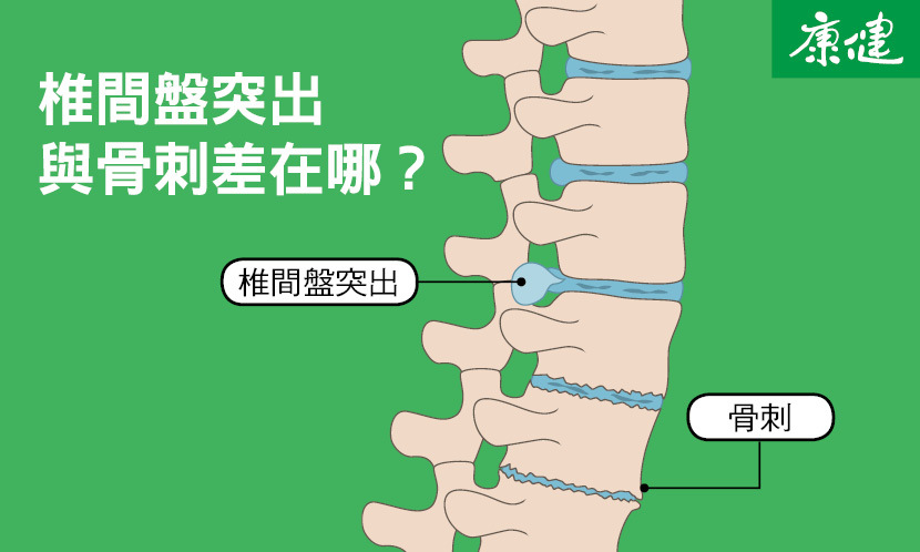 椎間盤突出與骨刺的差異
