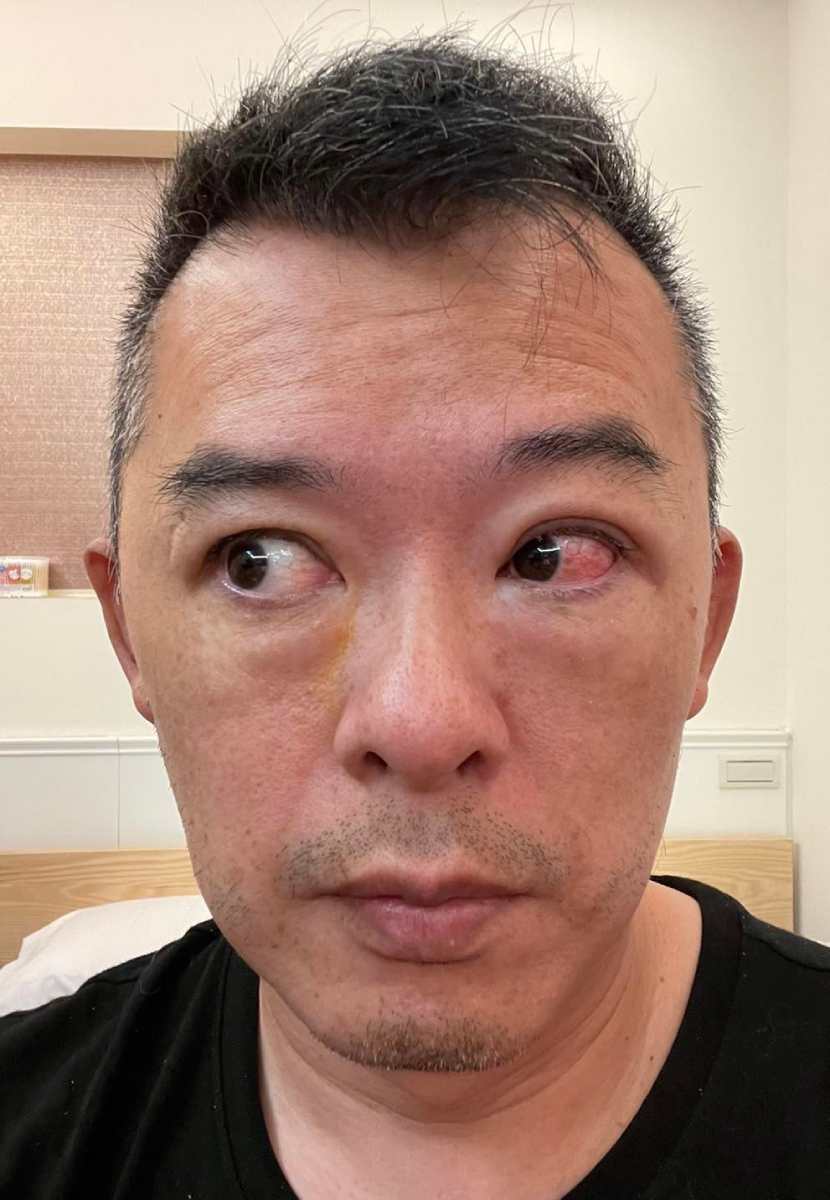 Andy老爹眼角膜灼傷