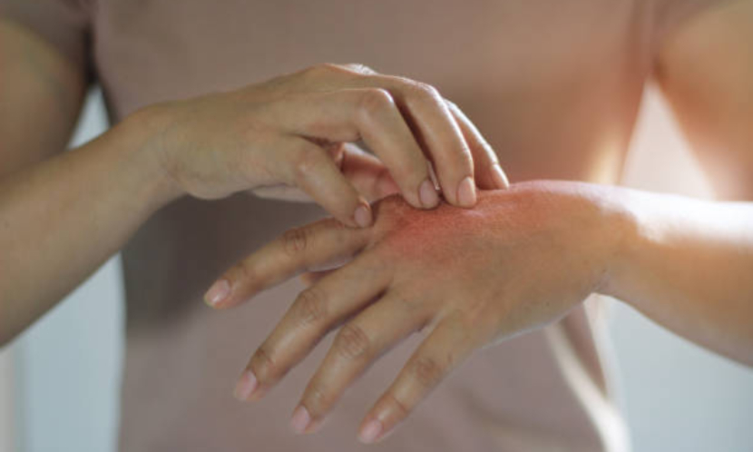 汗皰疹｜手腳狂冒小水泡又癢又痛　與流汗、汗腺發炎無關