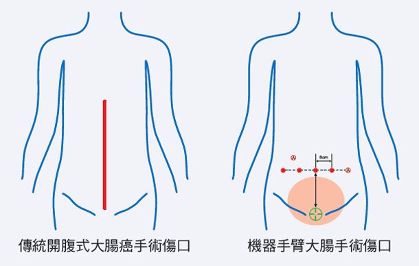 大腸手術傷口