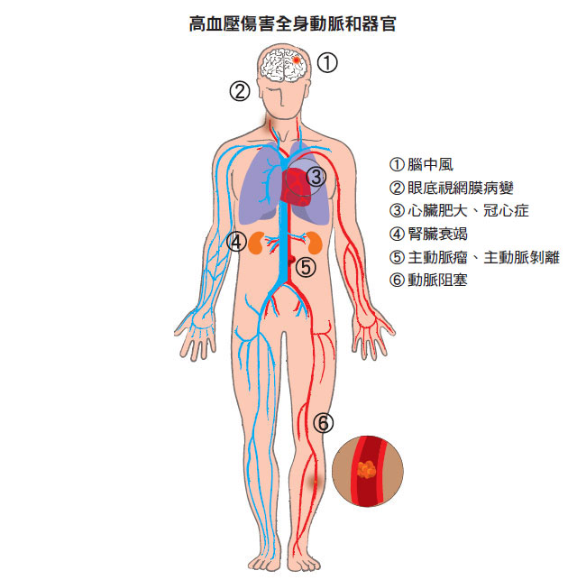 高血壓若不控制,對身體主要器官的戕害