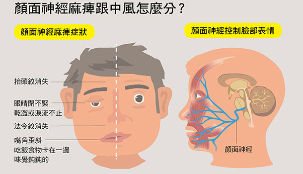 中西醫治好我的顏面神經麻痺