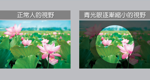 【閱讀全文】青光眼:視力1.0 卻走上失明之路