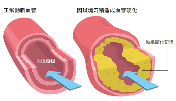 007 膽固醇太高,會塞住血管?