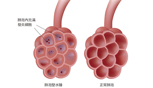 074 為什麼有人感冒一兩天就很快變成嚴重肺炎?