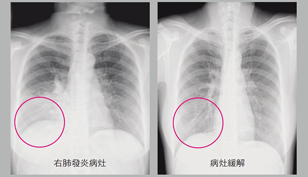 076 引起肺炎的原因有哪些?