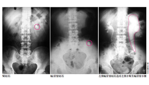 071 同樣是結石,為什麼醫生說我要開刀,不能用打的?