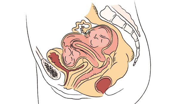子宮內膜為什麼會亂跑?