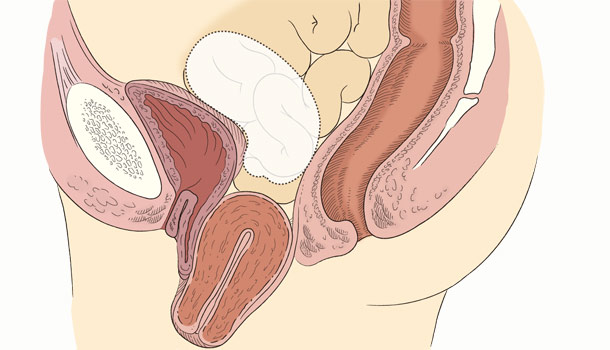 子宮脫垂怎麼治療?