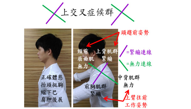 張凱翔:常落枕?偏頭痛?可能是「交叉症候群」