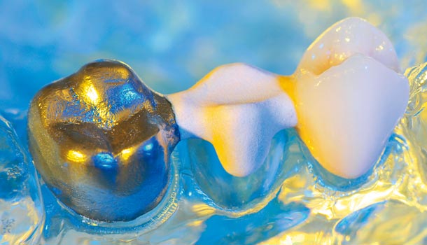 小孩蛀牙為什麼裝乳牙膠質牙套、不鏽鋼牙套?