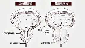  攝護腺癌對大腹翁殺傷力大　防堵轉移３關鍵