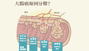 現況篇：大腸癌1、2、3、4 期怎麼分？
