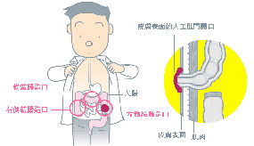 知識篇：圖解人工肛門是什麼？如何照顧？